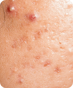 Acne Control