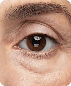 Fine Lines / Wrinkles